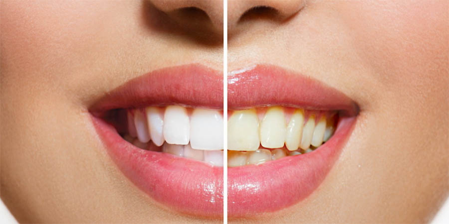 Teeth Whitening